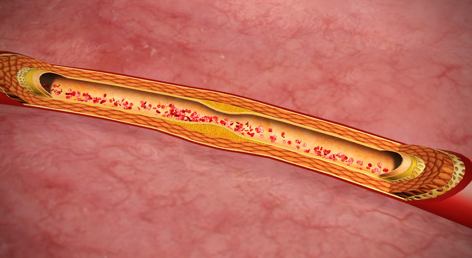 Atherosclerosis