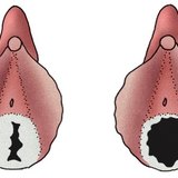 Залуу охины онгон хальс (зүүн талд) болон идэвхтэй бэлгийн амьдралтай эмэгтэйн онгон хальс (баруун)