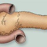 Нойр булчирхай